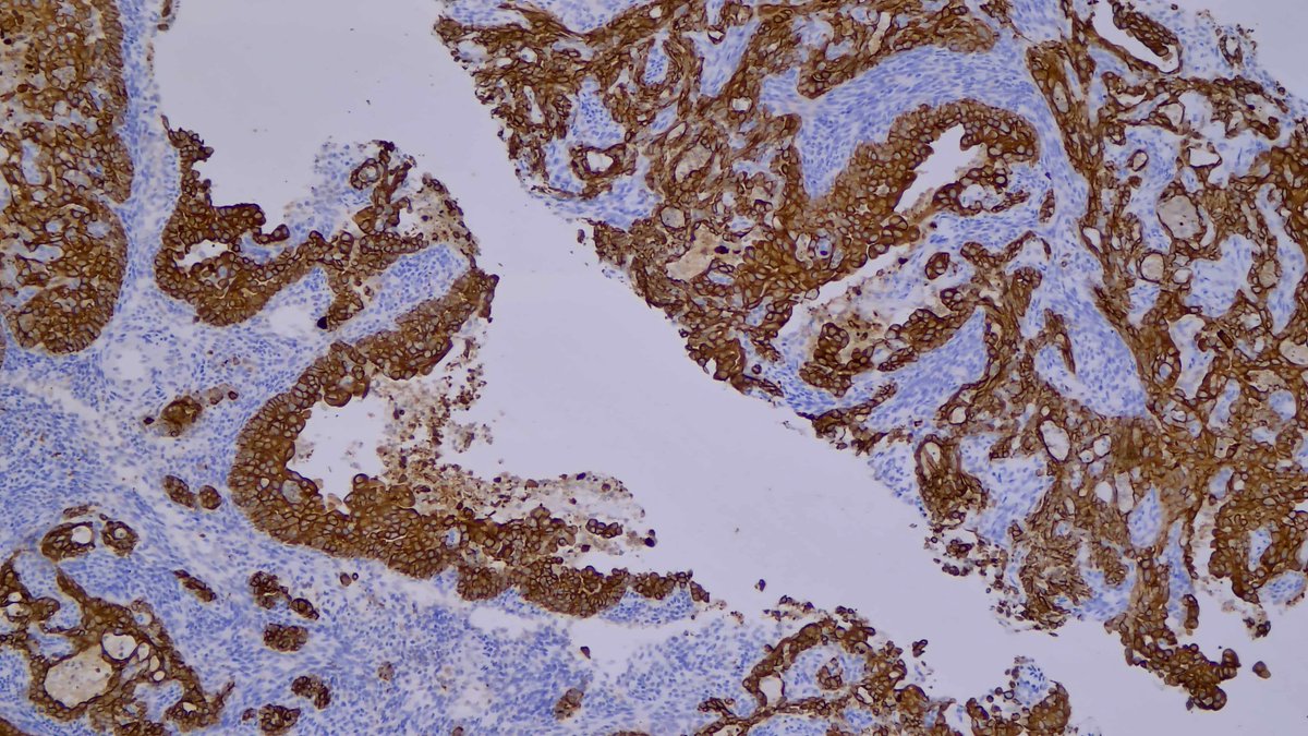 JDCo2pock's tweet photo. 36F, foot mass, bx. Malignant-appearing glands with luminal necrosis, expressing AE1/AE3 and GATA3, with accompanying stroma unusual for adenocarcinoma. TLE1 expression diffuse in glands and stroma. SS18 rearranged by FISH. Biphasic synovial sarcoma. #PennPath #BSTpath https://t.co/FRilXbw6HJ