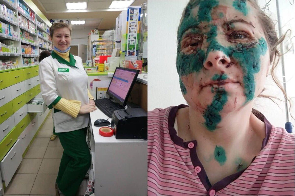 dkaleniuk's tweet photo. This is Nina. She is a professional pharmacist from Kharkiv. 
Nina agreed to show her face after after russian shelling. To make the world know the truth.
The woman will need a very long treatment. Who can help?
Stop #TerroRussia https://t.co/GRuJCCQkKP