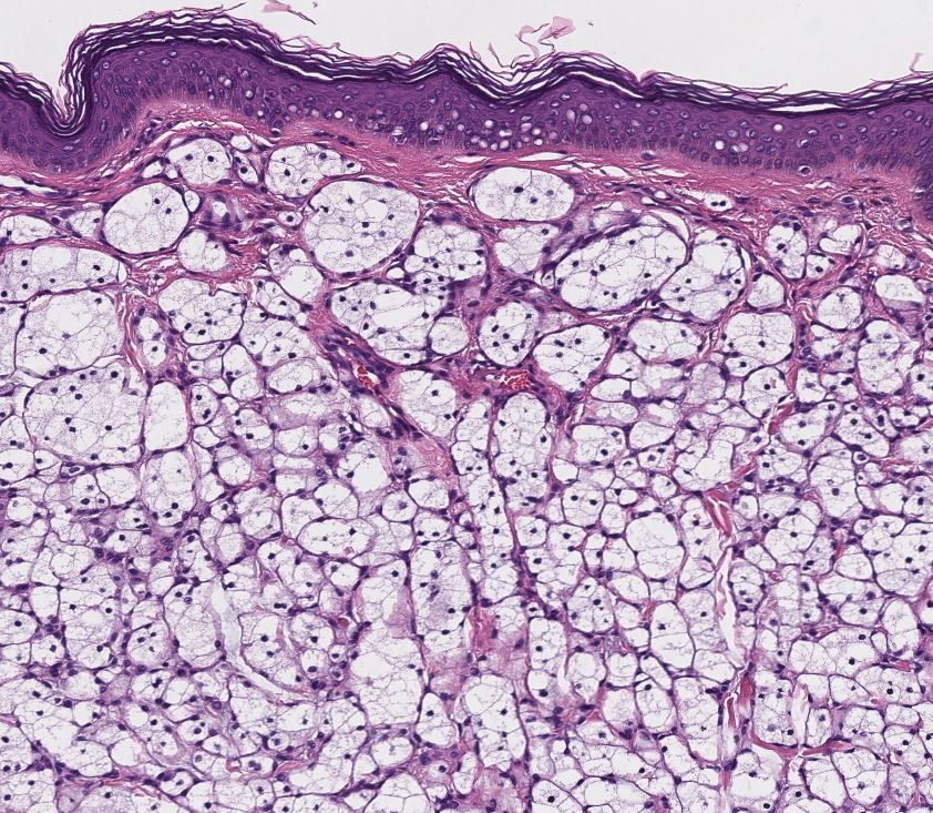 Another fun case...this one was a consult #dermpath #PathTwitter