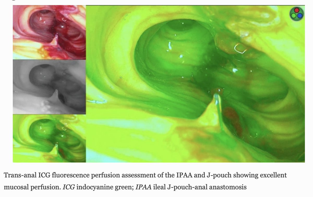 Following pouch lengthening manoeuvres should ICG 🟢🔦 be used routinely to ensure pouch vascularity? Read this paper & discuss👇bit.ly/3wxk4k9 @stevebrownsheff @AdeleSayers @AntoninoSpin @MissLHancock @colorectal_jay @OmarFaiz_SETOC