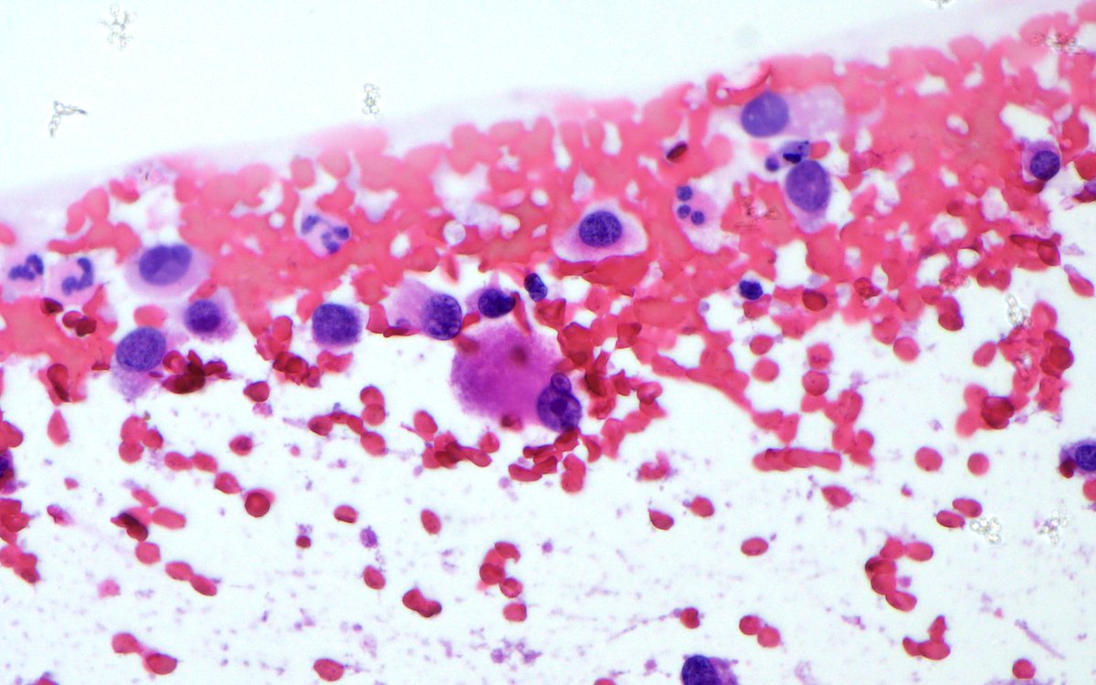 bitar_mireille's tweet photo. "Glial, or Not Glial, that is the question" Differential? #brainmass #smearpreparation #cytology #cytopath #dermpath #PathTwitter #neuropath https://t.co/8v2G3g6VlT
