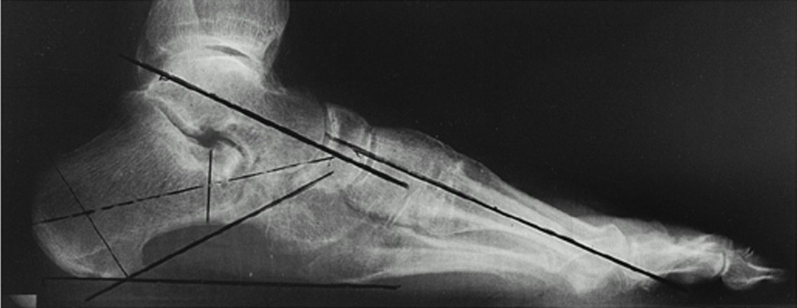 jbjs's tweet photo. Updated #footandankle #JBJSClinicalSummary on Progressive Collapsing Foot Deformity (#PCFD): Pathophysiology and Diagnosis
By: Cesar de Cesar Netto, MD, PhD
https://t.co/vrtwWy4wrA https://t.co/eP46laP6TZ