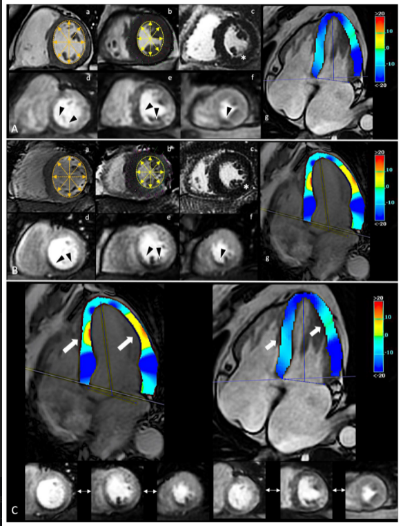 diagnostic_mdpi's tweet photo. @diagnostic_mdpi Stress Perfusion #Cardiac Magnetic Resonance in Long-Standing Non-Infarcted Chronic #Coronary Syndrome with Preserved Systolic Function. View Full Text: https://t.co/BKYgAVbupN. From the special issue edited by Prof. Dr. Minjie Lu @fwkan and Dr. Arlene Sirajuddin https://t.co/AawUTEvnhB