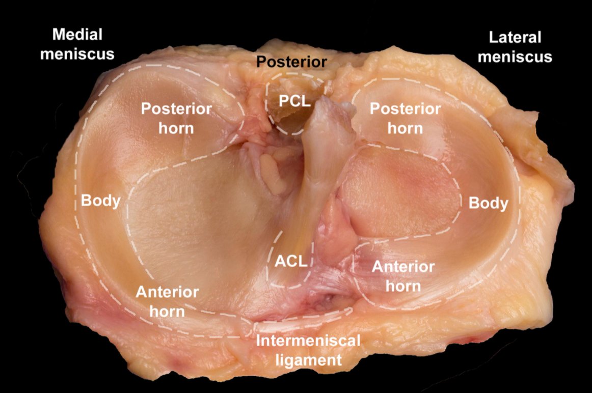 jbjs's tweet photo. Updated #JBJSClinicalSummary #Knee #Sportsmed #OrthoTwitter on #Meniscal Injuries
By: Latifah Al Mana, MBBS; @moinkhan_md; and Asheesh Bedi, MD
https://t.co/g92B2XaYwP https://t.co/OPmRK4WvS9