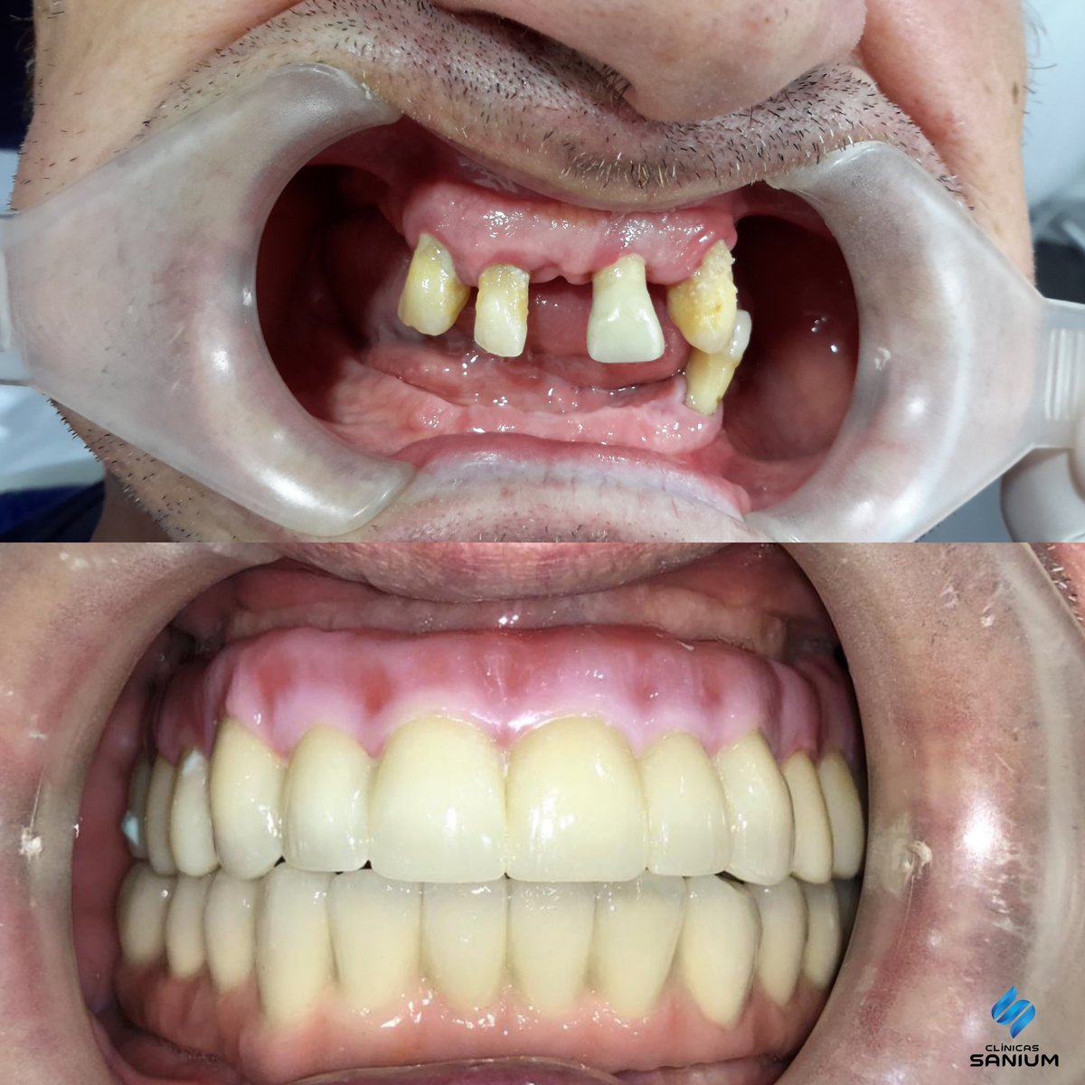 clinicassanium's tweet photo. Before &amp; After ✨

Tras un trabajo de rehabilitación completa superior e inferior con colocación de 6 implantes superiores y 6 implantes inferiores, el resultado fue increíble. 😍 https://t.co/9nT4ZlaLQz