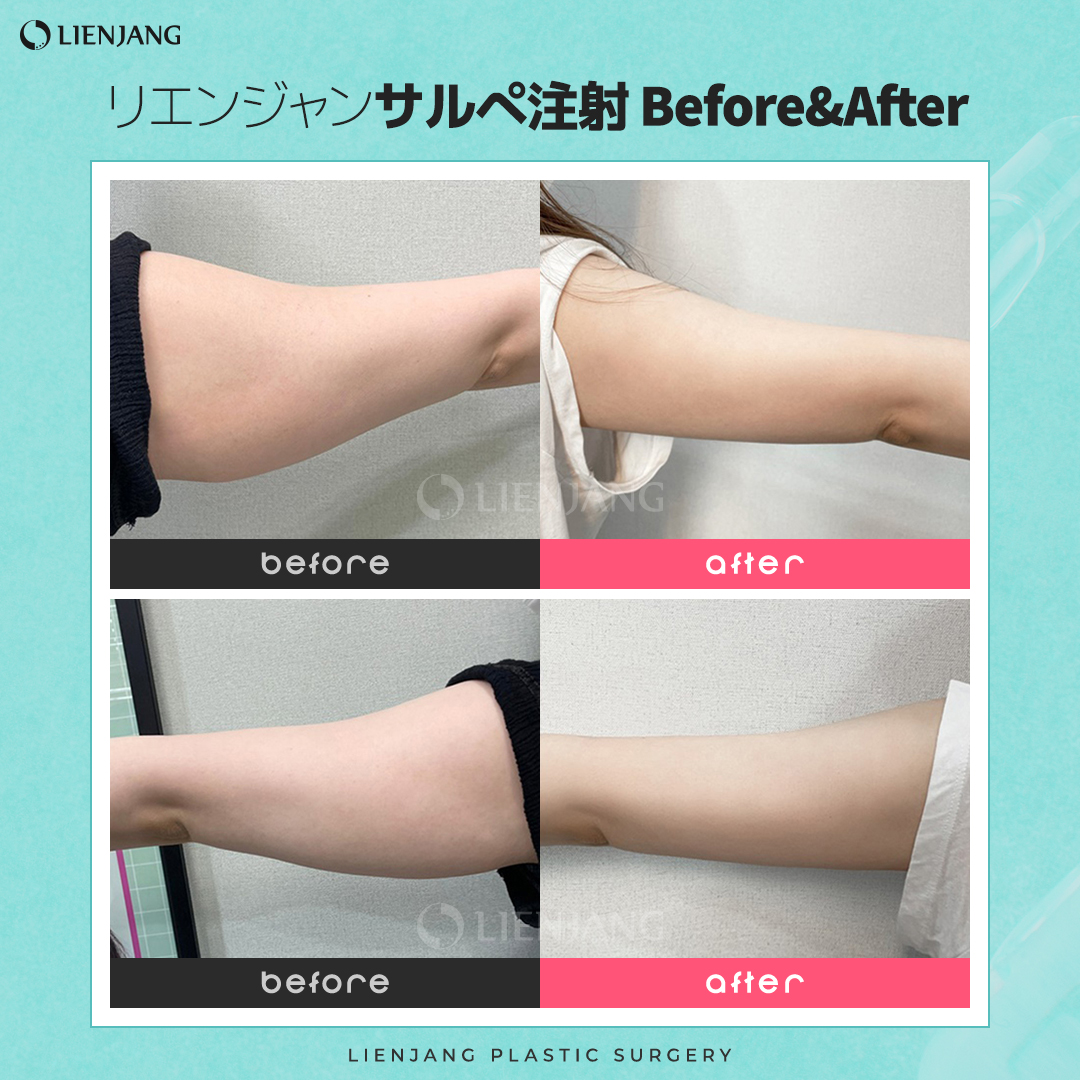 韓国リエンジャン美容外科 リエンジャン サルぺ注射 サルぺ注射とは 살빼 サルぺ 痩せるという意味の体型管理注射のことです 夏に向けてダイエットをしている方が多いこの時期 皆さんの美ボディ作りをお手伝いできればと思います 公式line