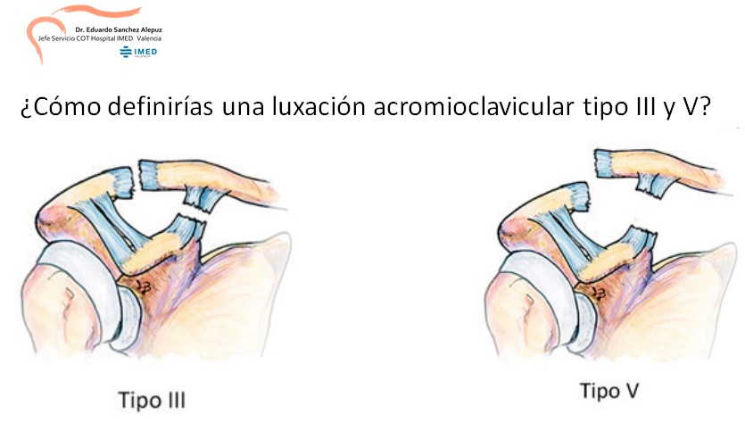 Un reto: ¿Cómo definirías una luxación acromioclavicular tipo III y V? 
🤔¿Te animas a participar?
🏋️ Yo he encontrado diferentes definiciones