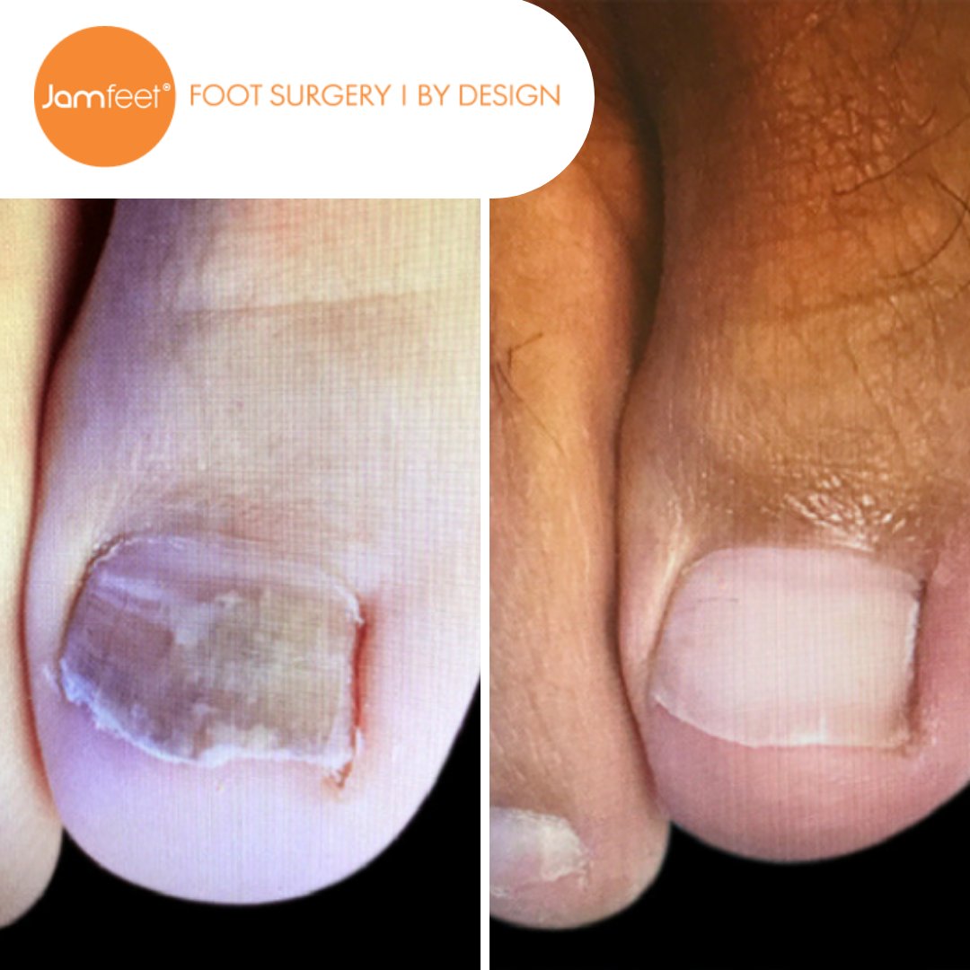 towerfootnankle's tweet photo. Our clinical studies to date reveal that over 88% of treated patients show significant improvement in our toenail fungus treatment. Take a look at more of our before and afters on our website -
📞 310.579.2080
💻 https://t.co/4oWDKqNBRf
🚗 LOS ANGELES / BEVERLY HILLS/ SHERMAN OAK https://t.co/5SCHRY2XzW