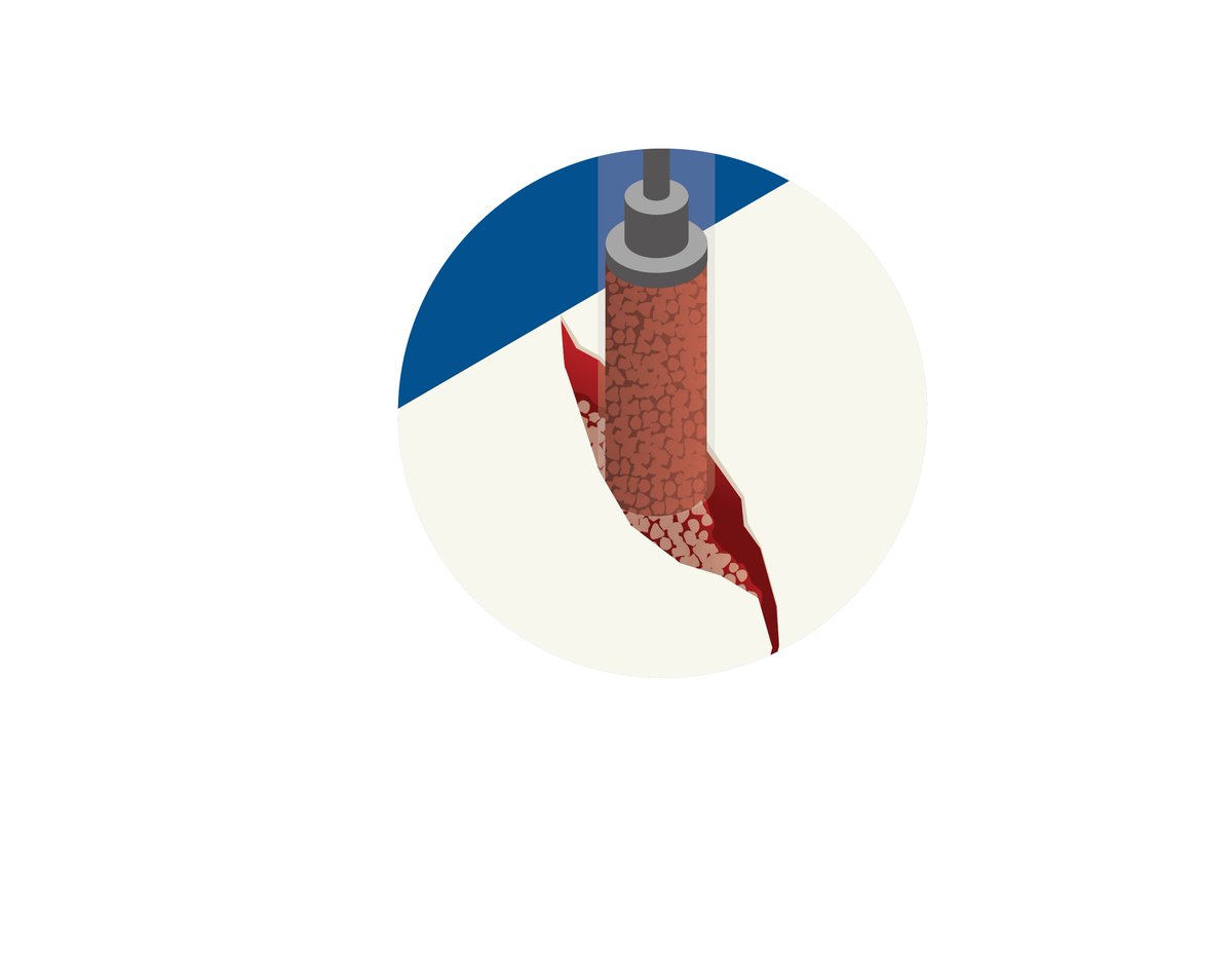 #boneregeneration #tissueregeneration #mbcptechnology #step1 #graftimplantation #cellcolonisation The first step in the bone regeration process is graft implantation after which cell colonisation is initiated and blood and growth factors migrate to the surgical site. #followus
