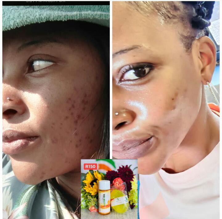 k_mkhensi's tweet photo. #10pM

#umgaleloafrica provides skin products, v-cleanser and steaming herbs🔥🔥 to provide solutions of skin problems like dry skin, pimples, darks spots, bacterial growth and period pains. For more information text me on 082 858 4839 🔥🔥 https://t.co/TDGlbIVdbx