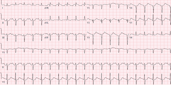 ACCinTouch's tweet photo. 47 y/o highly active female with past history of RA presented with #lightheadedness and diaphoresis after crossing the finish line at the local marathon. Review her #EKG and read more of her history to vote on a diagnosis ⬇️ 

https://t.co/dl9mZKWyzz #ACCEd https://t.co/OfcAcwYNUQ