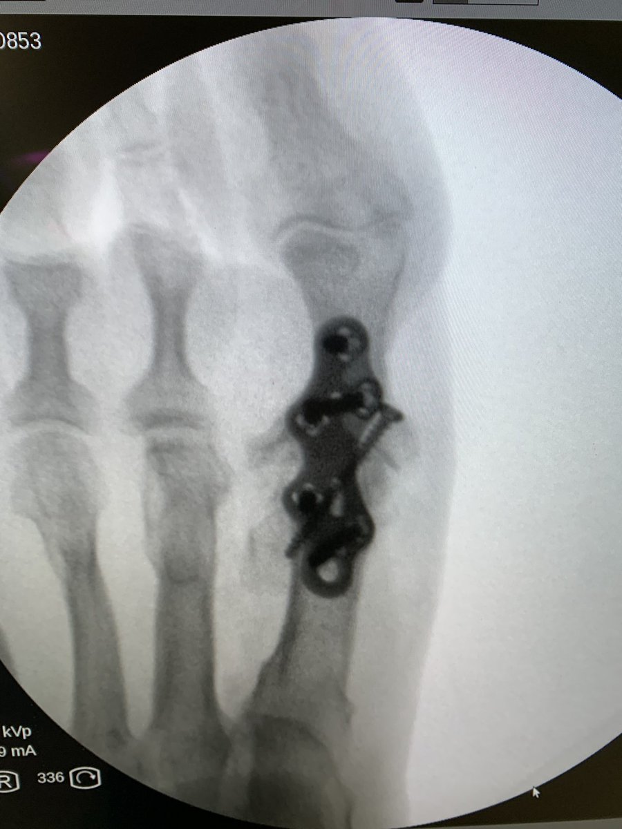 DrRamonNavarro's tweet photo. Otra opción en el manejo del #hallux varus postop es la #artrodesis MTF

La utilizamos cuando existe artropatía asociada a la deformidad 

Técnica Unidad de Pie y Tobillo @ClinicaCEMTRO https://t.co/YWUYezaWFA