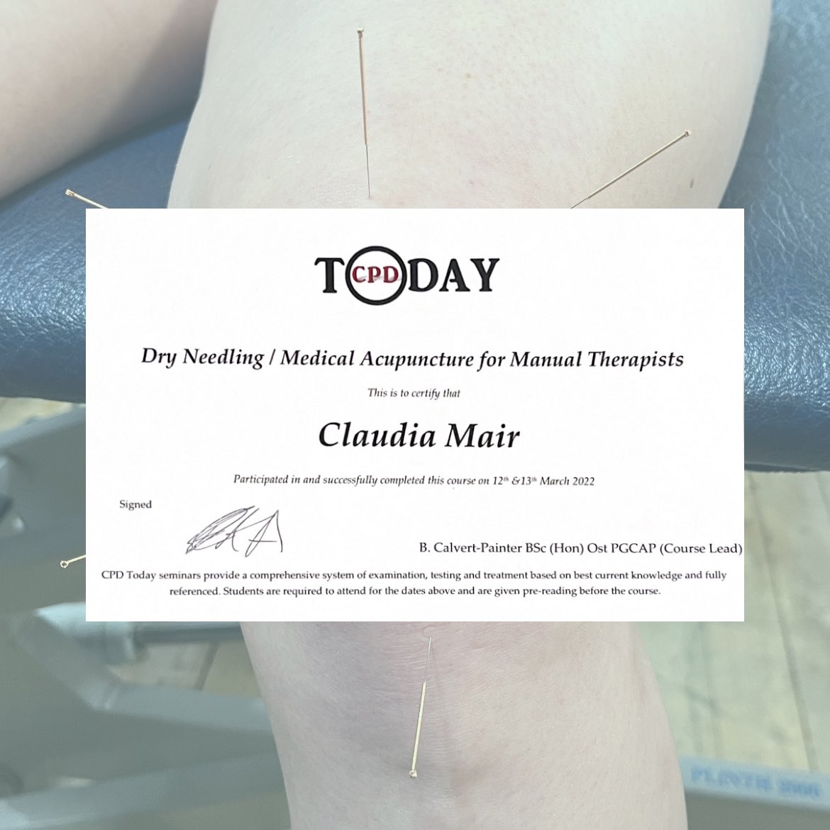 Glad to have achieved my dry needling and medical acupuncture qualification. I’ve had a great time learning and practicing the techniques and can’t wait to use them within my practice.