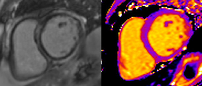 Is a non-contrast CMR study with T1 mapping good enough to show the full picture and replace a LGE study #WhyCMR