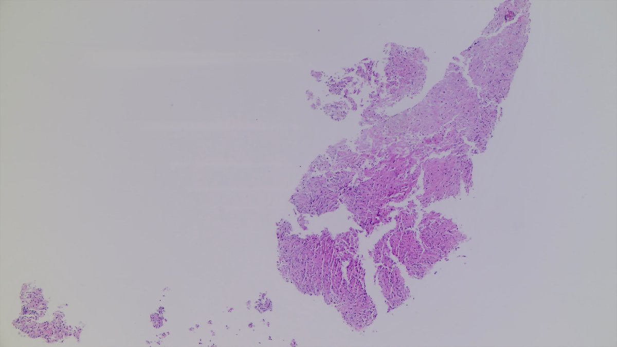 JDCo2pock's tweet photo. HIV+ patient, liver biopsy with concern for lymphoma. Necrotic spindle cell tumor? Or the great mimicker? Not that one (melanoma), the other one (see spirochete stain). https://t.co/CvVaWJaEoX