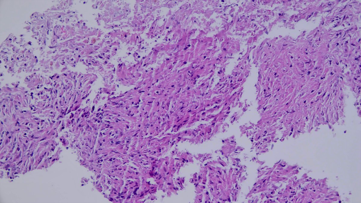 JDCo2pock's tweet photo. HIV+ patient, liver biopsy with concern for lymphoma. Necrotic spindle cell tumor? Or the great mimicker? Not that one (melanoma), the other one (see spirochete stain). https://t.co/CvVaWJaEoX