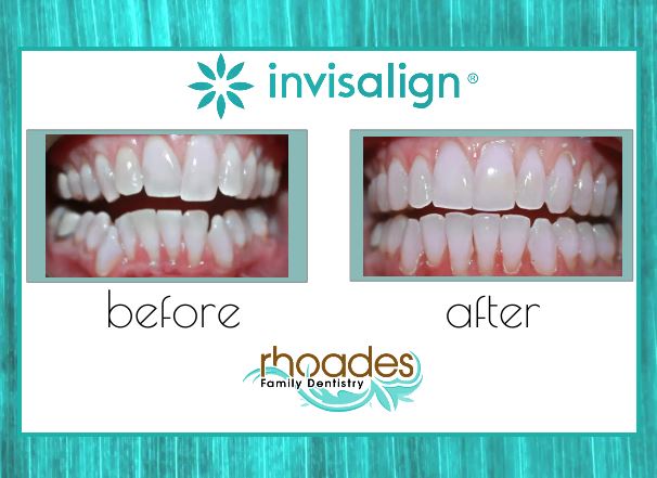 rhoadesdds's tweet photo. One Week left to save $1,000 OFF INVISALIGN! You don't want to miss this 💐Spring Special ~ Call to schedule your FREE INVISALIGN CONSULTATION #KC #Invisalign #InvisalignSpecial #InvisalignSale #Olathe #KansasInvisalign #KansasDentist #OlatheDentist https://t.co/Jrjb4KHoDQ