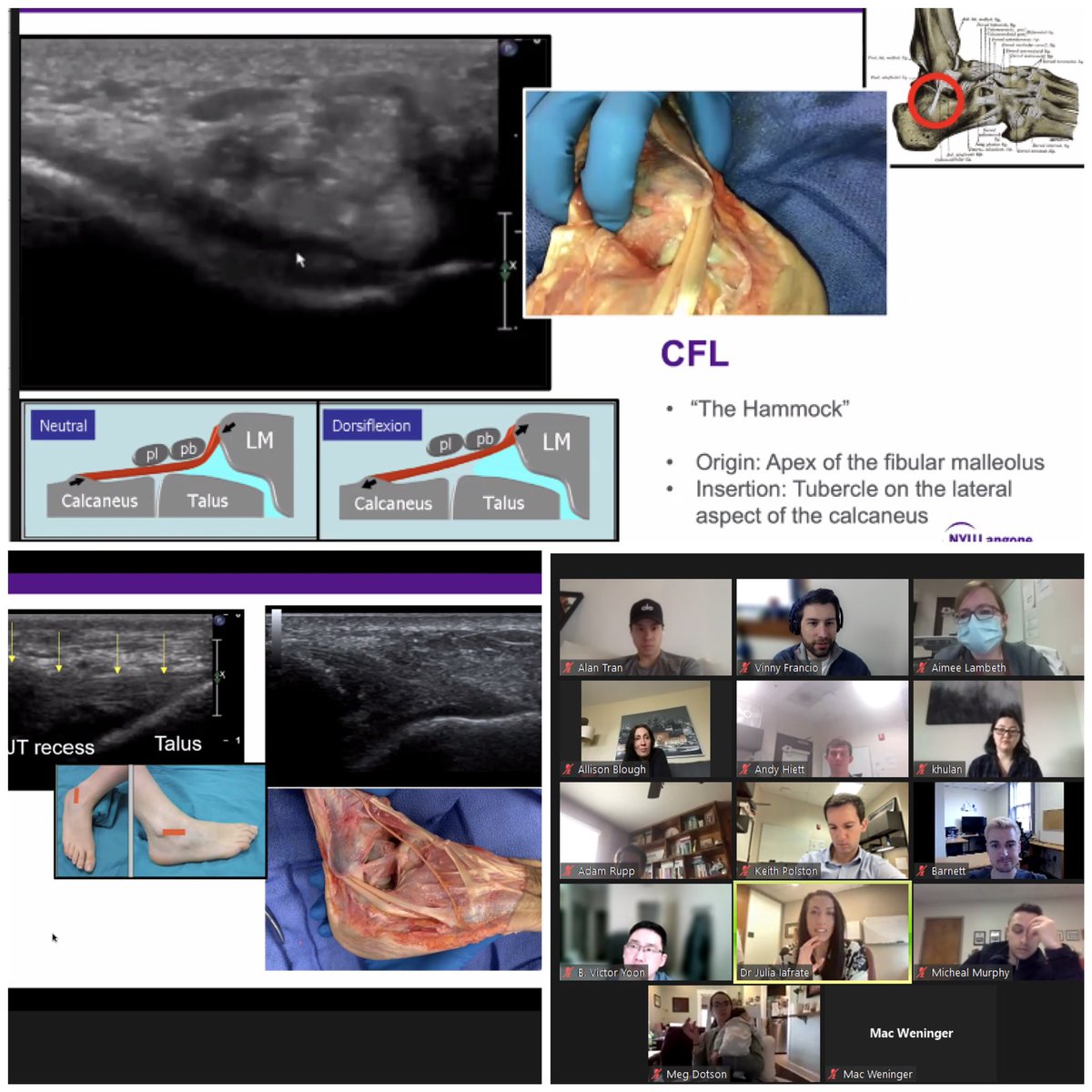 Great lecture with <a href="/thenewDrJ/">Dr. Julia Iafrate, DO, CAQSM, FAAPMR</a> from <a href="/nyulangone/">NYU Langone Health</a> discussing #SportsMedicine #Dance and #PerformingArts #Physiatry <a href="/AAPhysiatrists/">Assoc. of Academic Physiatrists (AAP)</a> <a href="/AAPhysiatry_RFC/">AAP Resident Fellow Council PM&R</a> <a href="/AAPhysiatry_MSC/">AAP Medical Student Council PM&R</a> <a href="/AAPMR/">AAPM&R News</a> <a href="/PmrScholars/">PM&R Scholars</a> <a href="/physiatrynow/">PhysiatryNow</a> <a href="/KUSportsMed/">KU Sports Medicine</a> <a href="/TheAMSSM/">AMSSM</a>