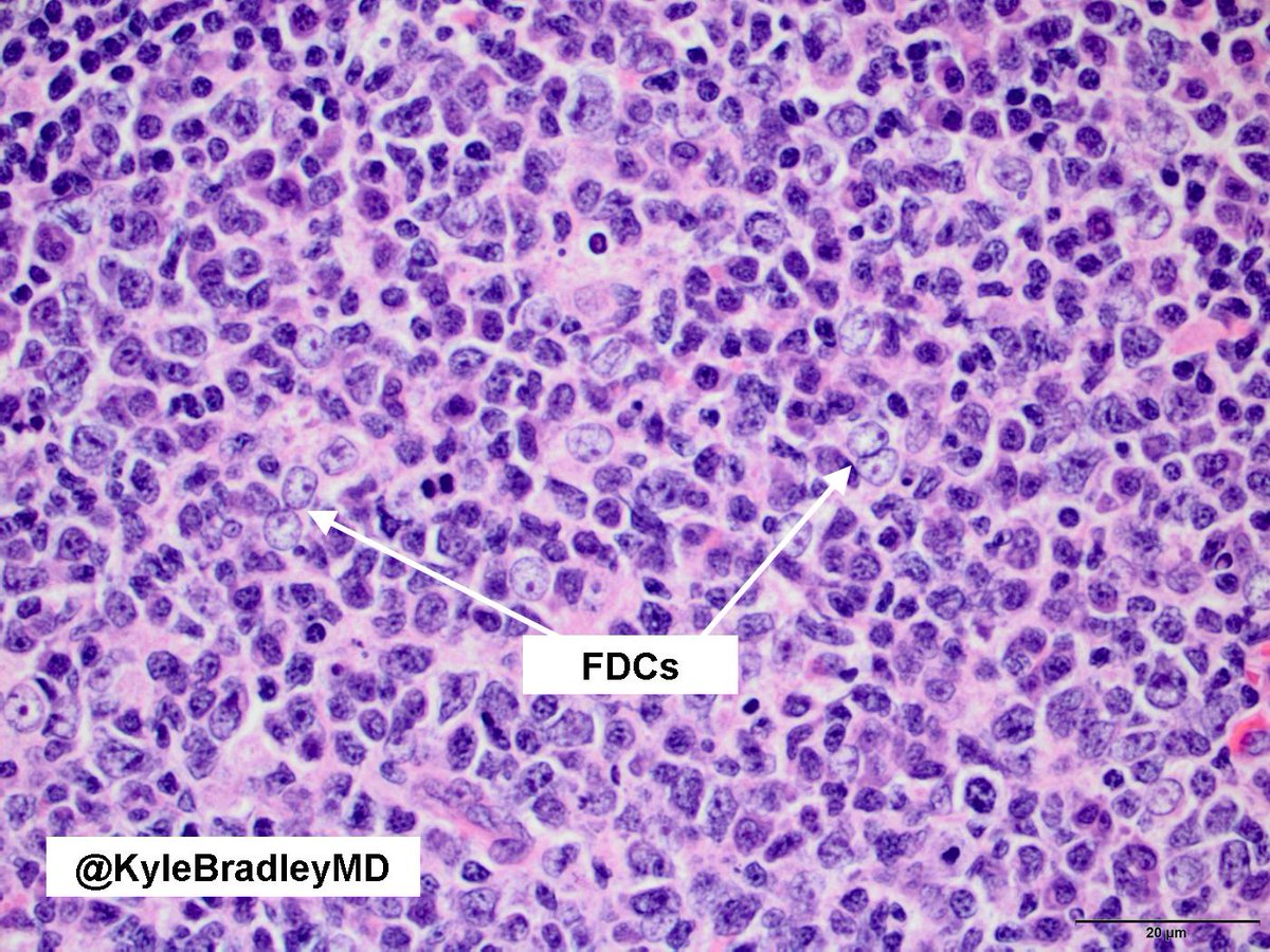 Want to learn how to recognize follicular dendritic cells in a lymph node?

Here are some tips: kikoxp.com/posts/10219

#hemepath