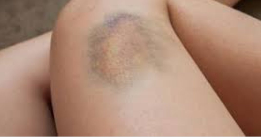 Asociación Fibromialgia Cuarta Región tweet media