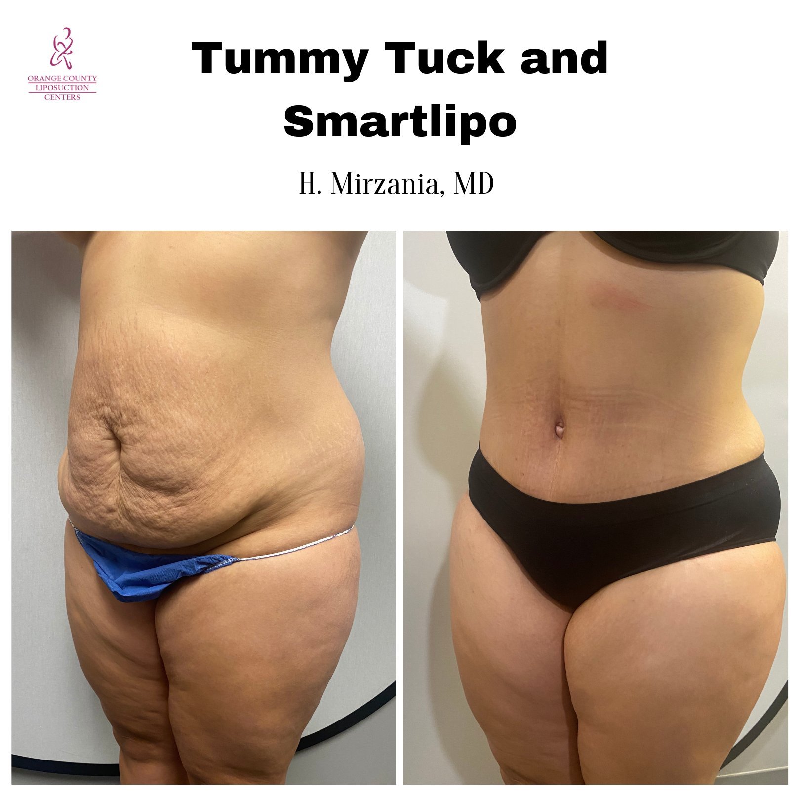 Los Angeles Liposuction Centers on X: Female patient 5 weeks after her  Full Tummy Tuck with Smartlipo 360. Amazing results all with local  anesthesia! Procedure performed by H. Mirzania, MD. #fulltummytuck # tummytuck #