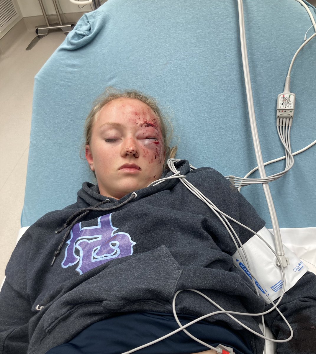 WEAR A FACE MASK!!
Two weeks before high school season started, I took a ball to the face playing 3rd during practice. 9 stitches and a orbital blowout fracture. Six weeks later and starting to get back to the game I love!! Hoping to get to play soon <a href="/HB_Softball/">Har-Ber Wildcats Softball</a> <a href="/CrushElite18U/">Crush Elite 18U</a>