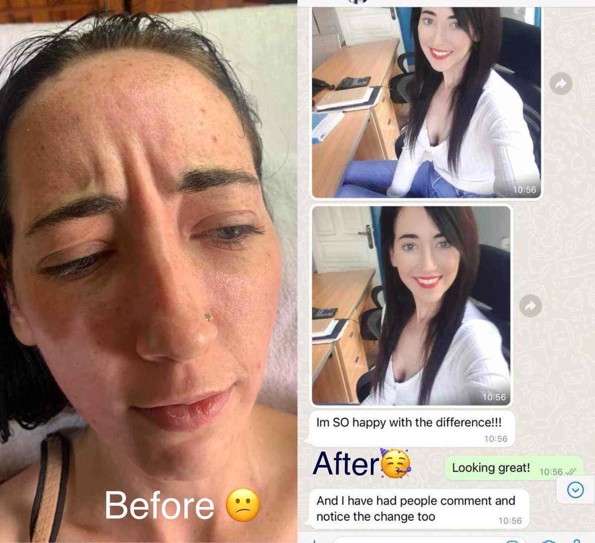 RefineClinicUG's tweet photo. Happy client🥳

Anti-wrinkle Injections; Before &amp; after!

Bookings: 0758 232 889.
🔗 https://t.co/ggM20MEyUT

#BeFlawless #AntiWrinkleInjections #Antiageing #Wrinkless #friday #skingoals https://t.co/lip3Zt39IF