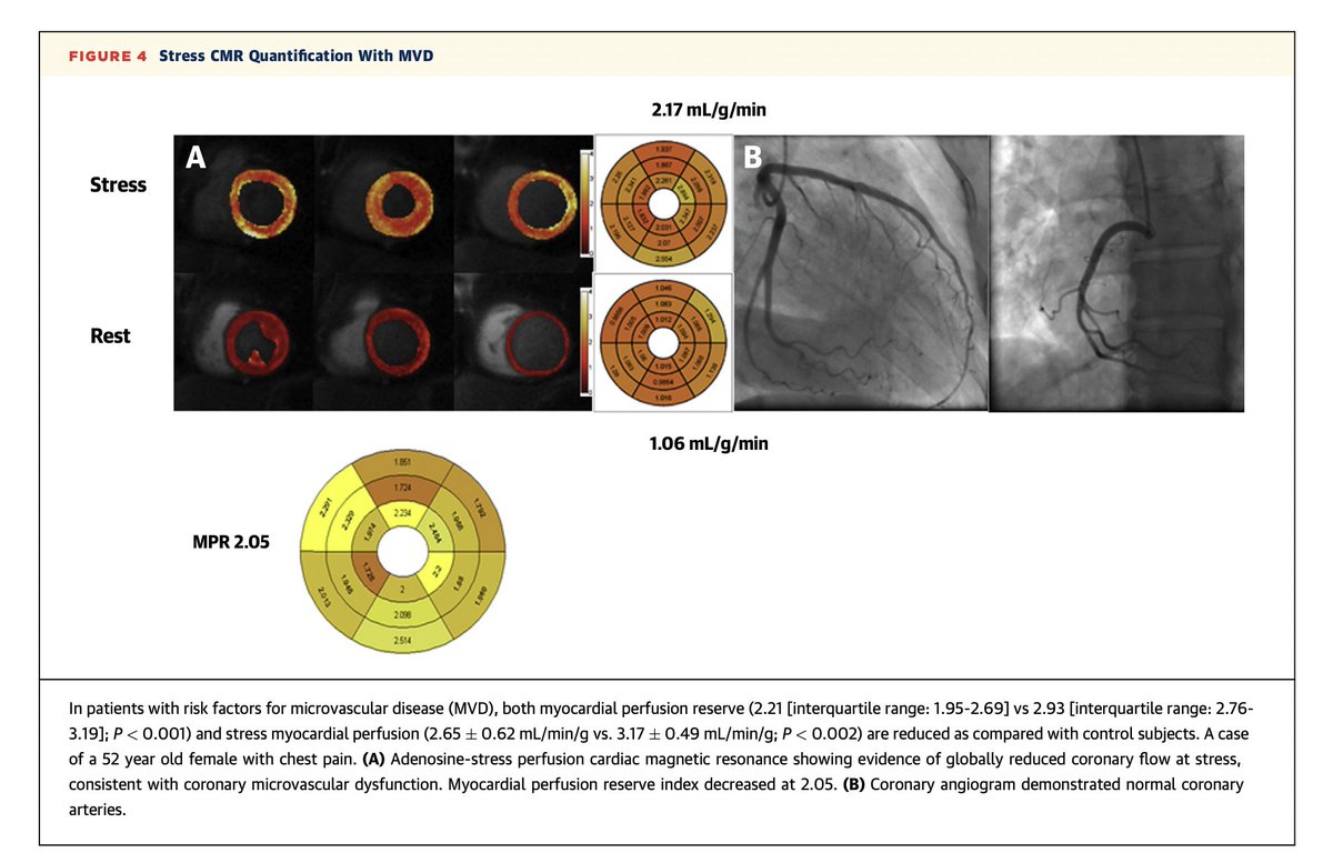 Fantastic multimodality imaging review for 📸 of IHD In women by the dream team! Must read for every cardiologist IMHO! #WOMENCVD #whyCMR #YESCCT #ECHOFIRST #JACCIMG 
🚺with ⬇️calcified lesions, ⬆️nonobstructive plaques, ⬆️prevalence of MVD compared to🚹

jacc.org/doi/abs/10.101…