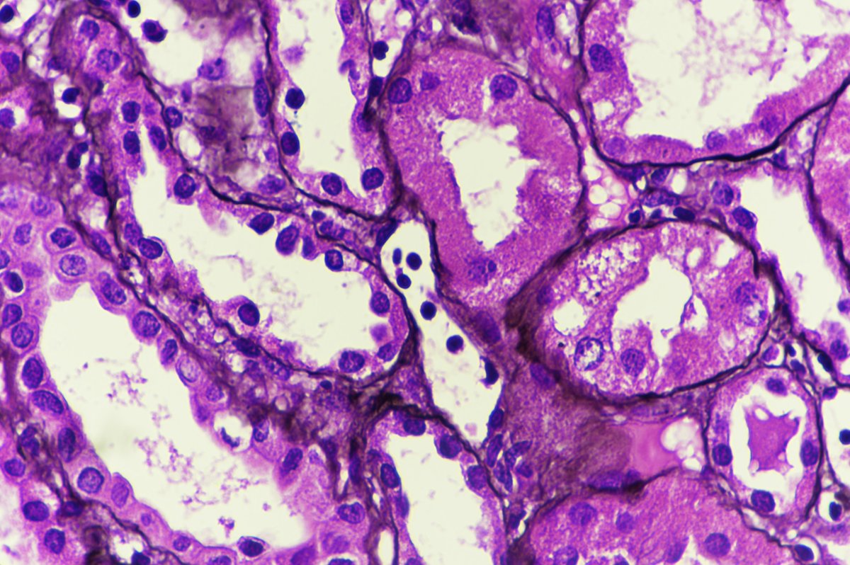 PreethiSekarMD's tweet photo. Active antibody-mediated rejection:
Glomerulitis
Peritubular capillaritis
C4d peritubular capillary deposition #renalpath https://t.co/rtTrwBePG0