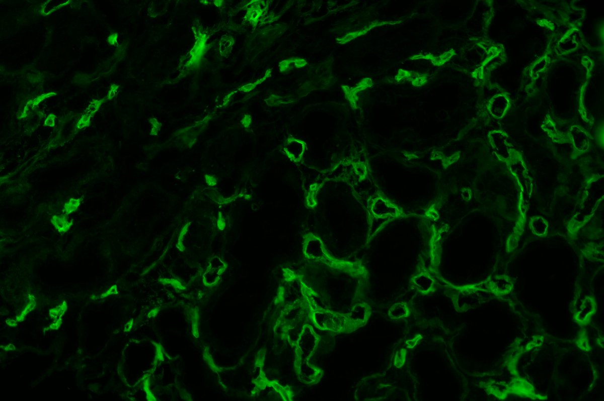 PreethiSekarMD's tweet photo. Active antibody-mediated rejection:
Glomerulitis
Peritubular capillaritis
C4d peritubular capillary deposition #renalpath https://t.co/rtTrwBePG0