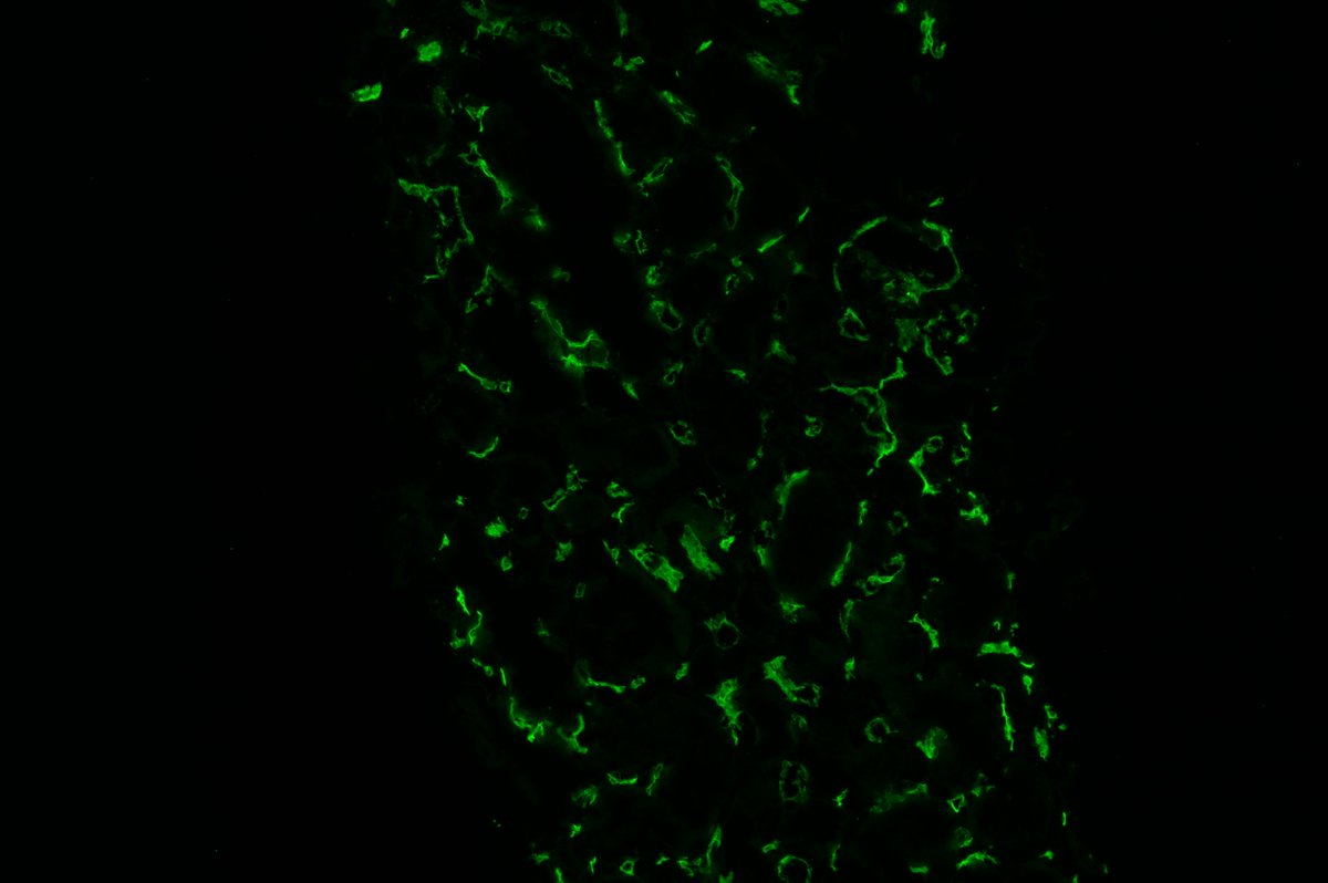 PreethiSekarMD's tweet photo. C4d peritubular capillary staining is frequently seen in ABO-incompatible renal transplants without histologic evidence of rejection and may represent a marker for stable graft accomodation. #renalpath
https://t.co/9h7q2mCzg5 https://t.co/4oWUHRs97u