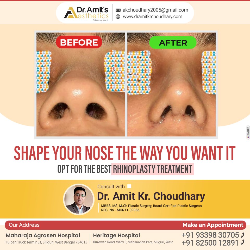 Shape your nose the way you want it to opt for the best Rhinoplasty Treatment.
For appointment : +91 93398 30705 || +91 82500 12891
dramitkrchoudhary.com
#shapenose #noseshape #Rhinoplasty #rhinoplastytreatment