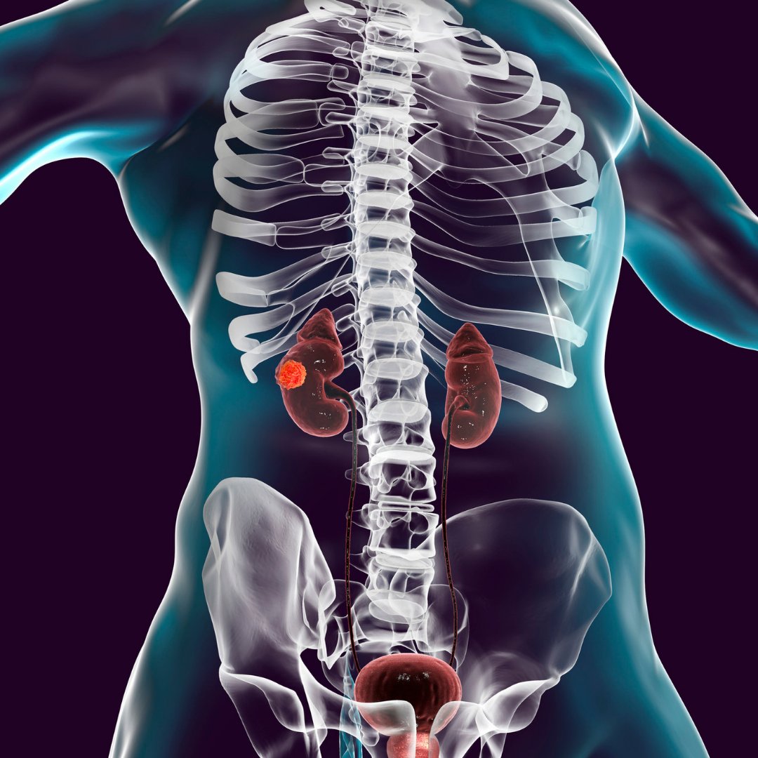 IronwoodCancer's tweet photo. March is not only #ColonCancerMonth; it is also #KidneyCancerAwarenessMonth. Also known as renal cancer, kidney cancer is often treated with surgery to remove all or part of the affected organ. https://t.co/Ggz6NUnY8b