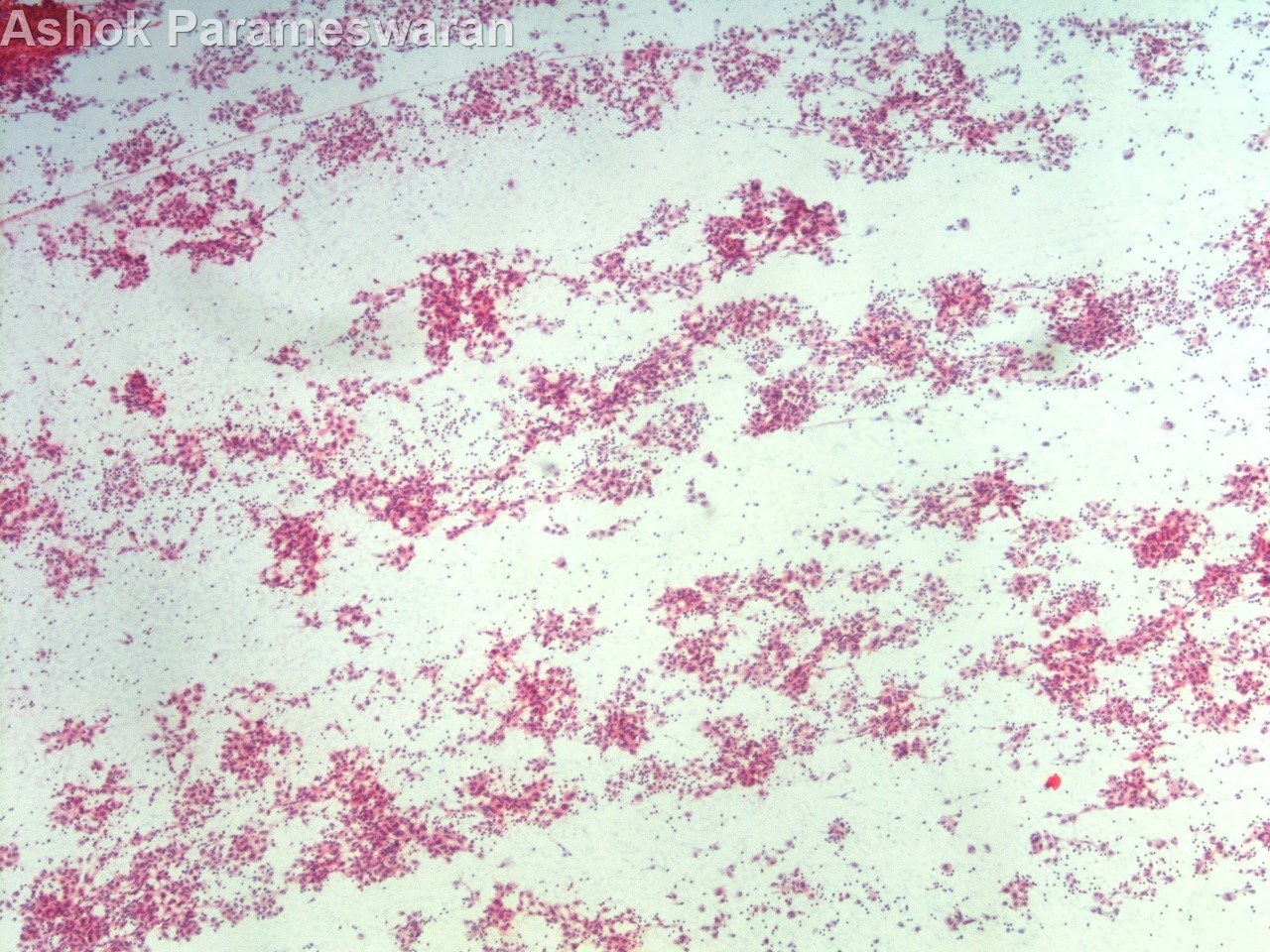 Ashok Parameswaran on Twitter "Peripancreatic lesion. EUSFNA, 44/F