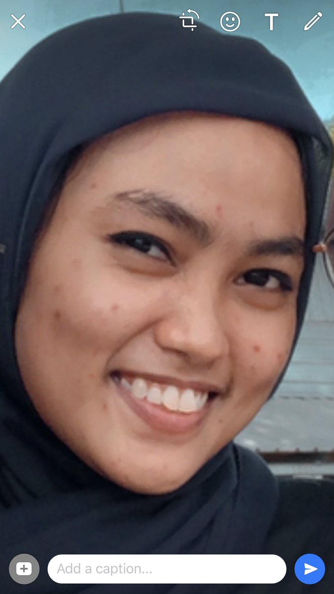 ciciiyma's tweet photo. Perlu kurang lebih 10 bulan sampai bener” ilang bekasnya https://t.co/uDI9fsfUGW