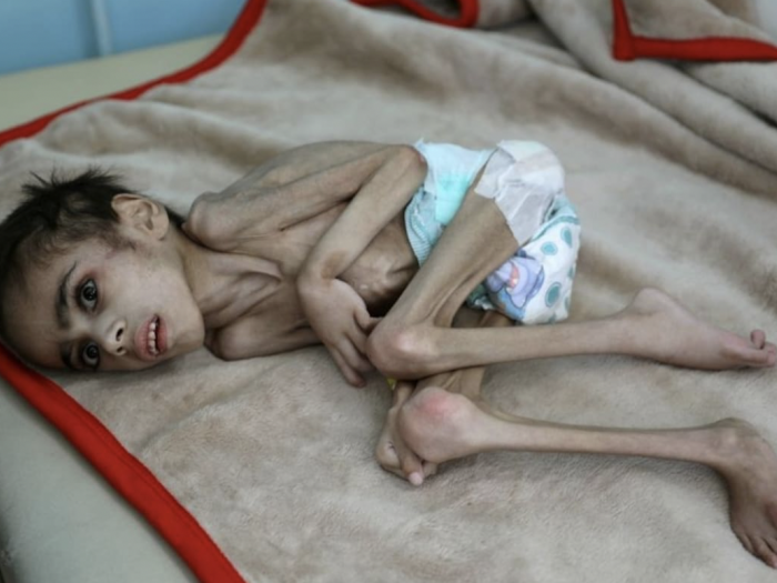 When one hears Yemen is world’s worst humanitarian disaster, often there’s a distancing effect. What it means in reality is 400K children, like this one, starving to death because of a UK-backed war and blockade. We should be doing all we can to end this crime against humanity