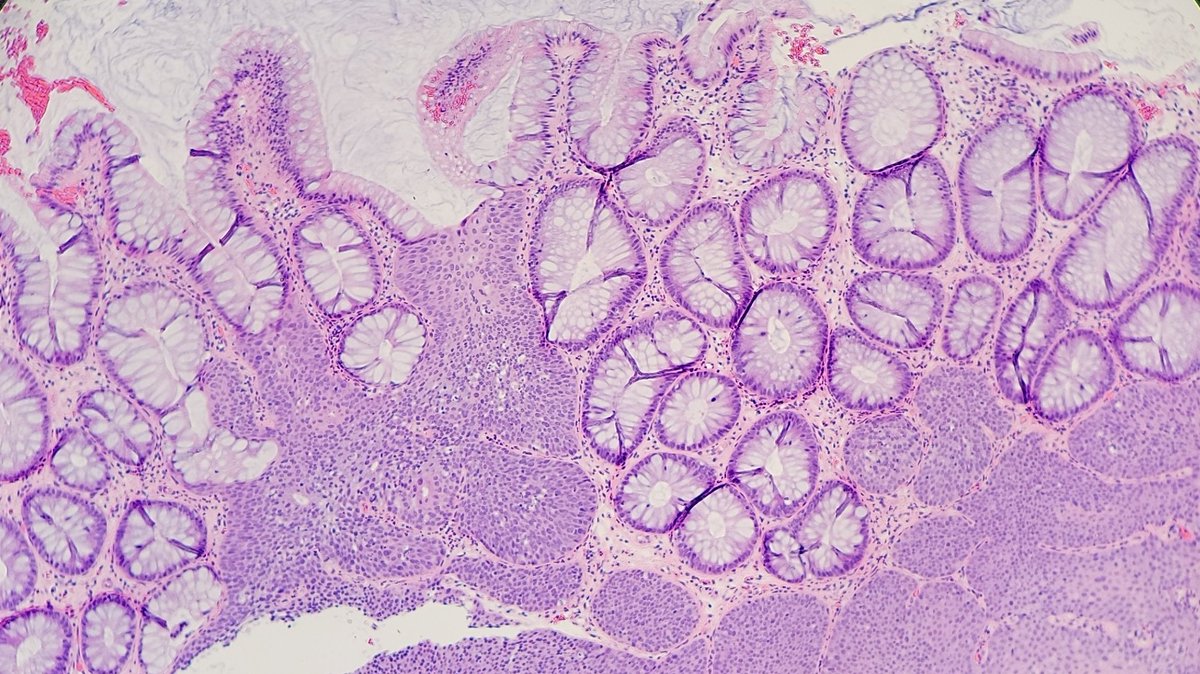 Nodular rectal mucosa.
#GIPath #pathology #PathTwitter #PathMatch22