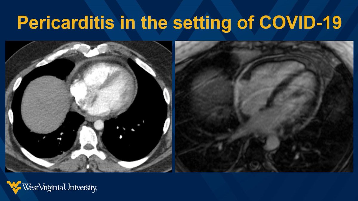 wvuradres's tweet photo. Poster presentation at #STR2022 by PGY3 #RadRes Dr Sri Kota on atypical causes of pericardial findings. @thoracicrad https://t.co/cJRQrozrTD