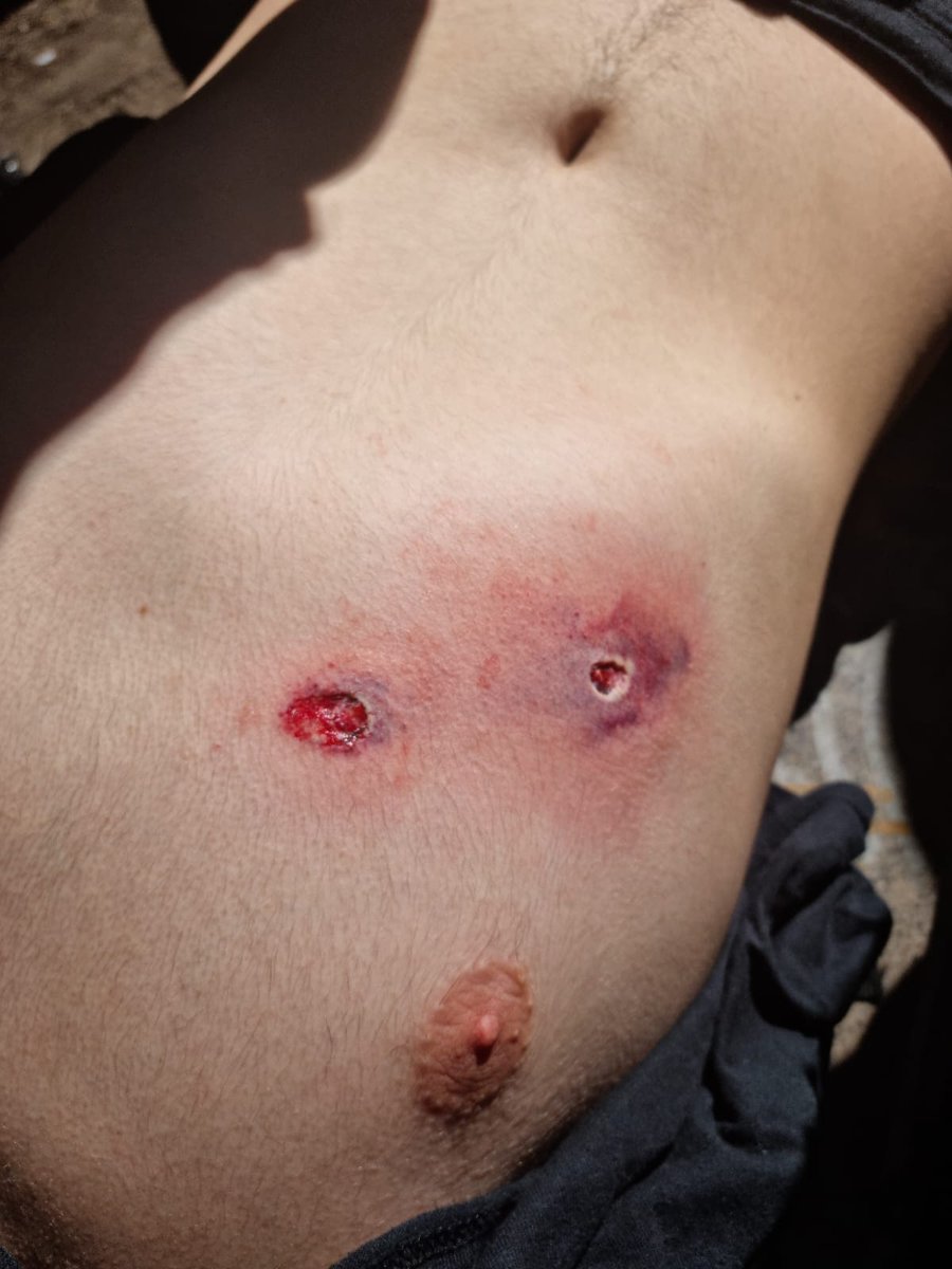 PiensaPrensa's tweet photo. URGENTE | Estudiante herido en el tórax por @Carabdechile -durante el desarrollo de una marcha realizada por la CONFECH- es atendido en la ex posta Central. Recibió una bala que afortunadamente lo atravesó. 
Funcionarios INDH están en espera de información en la ex posta. https://t.co/aHr8WID1KY