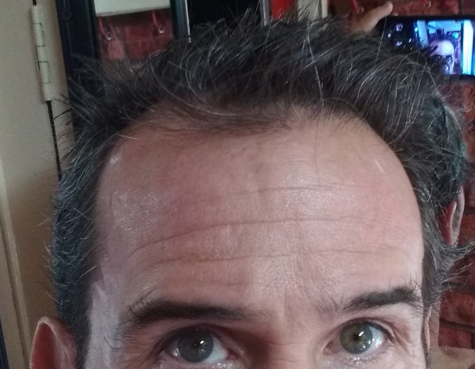 Today's the 1 year anniversary of my hair transplant. Before and after (taken today) pics. It's not perfect