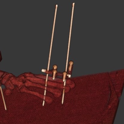 SkelObsLab's tweet image. Capstone team members and 4th-year @QueensMech students Kendall Glen and Sarah Poch testing their great mixed modality marker flag design! It&apos;s amazing to be back in the lab on a regular basis! @QueensMech @CHI_CIS @RainbowBiomech