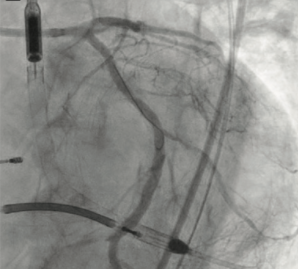 InvasiveCardiol's tweet photo. Read the latest from CLD’s #CalciumCorner! Image-Guided Calcium Modification: IVL
Dr @kevinjamescroce describes how his center relies on an intravascular imaging-based approach to deal with calcified lesions.
#CoronaryIVL @ShockwaveIVL #cardiotwitter
https://t.co/EFUX8zA3rp https://t.co/kgrNSwLrWZ