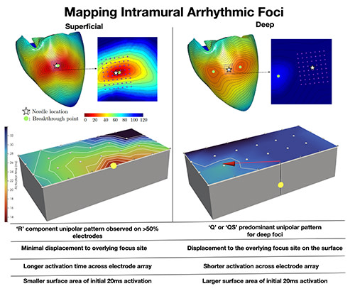Intramural ventricular foci are displaced from the exit surface site. Unipolar EGM patterns do not accurately guide deep sources, however, novel surface indices are useful <a href="/Dr_RobAnderson/">Robert Anderson</a>  #AHAJournals #Epeeps ahajournals.org/doi/abs/10.116…
