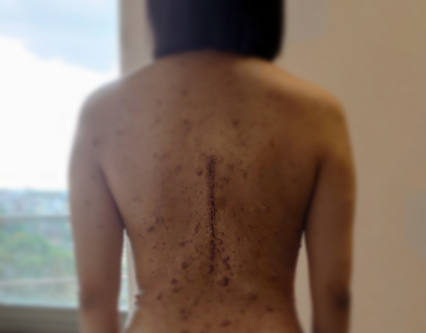 大河内愛美 指定難病と向き合うガラス作家 本当に綺麗になった 去年の6月に背部の神経線維腫を取れるものを全て取る手術を受け 現在がコチラです Mpnstの手術跡も綺麗になってきた 小さいモノは傷跡のが逆に目立つから大きくなるまでは取れ