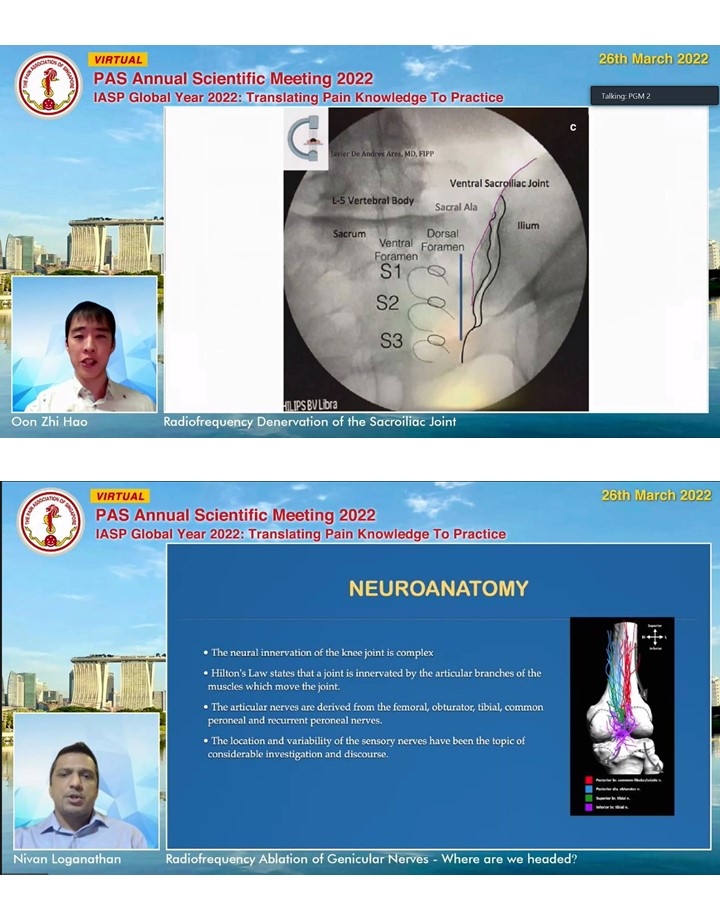 Say Yang Ong (@sayyangong) on Twitter photo Radiofrequency ablation of SIJ & Genicular Nerves featuring Dr Oon Zhihao and Dr Nivan Loganathan. <a href="/PASpainsg/">Pain Association Singapore</a> #PASASM2022 Radiofrequency ablation of SIJ & Genicular Nerves featuring Dr Oon Zhihao and Dr Nivan Loganathan. <a href="/PASpainsg/">Pain Association Singapore</a> #PASASM2022