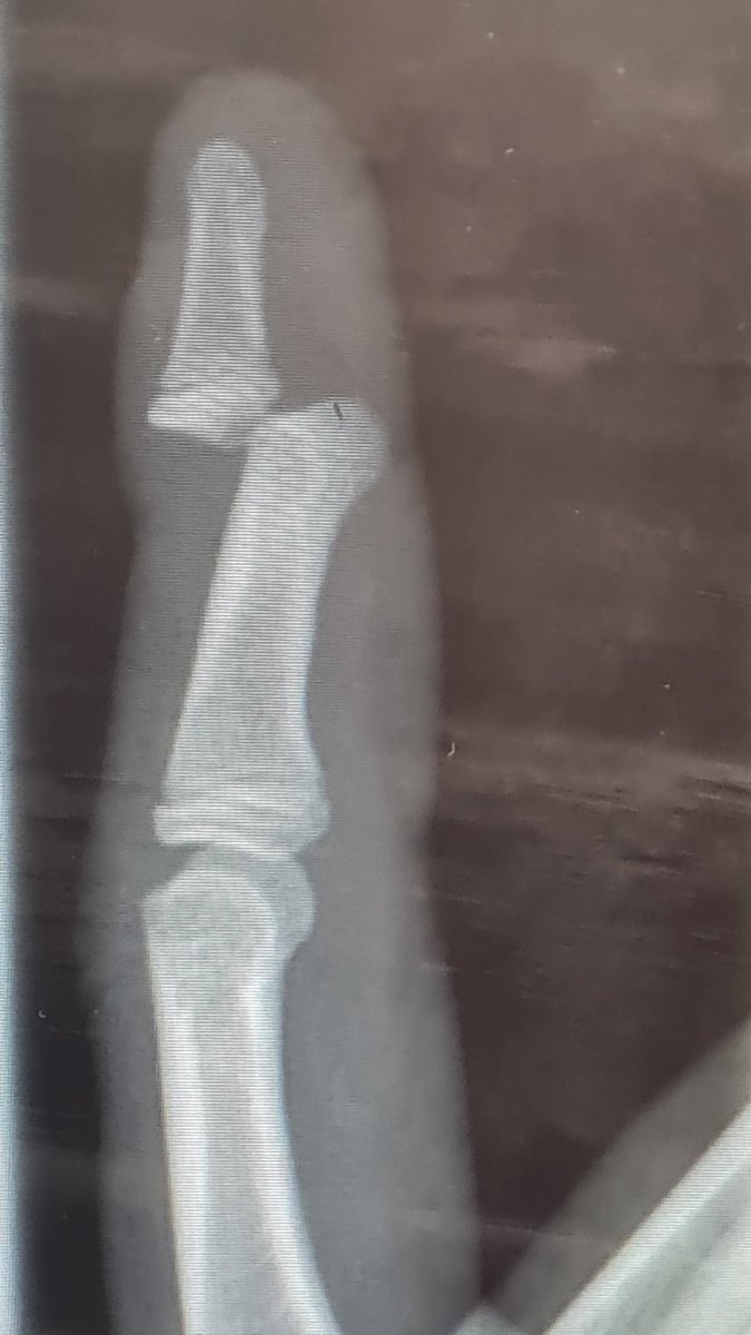 SirWilfredUK's tweet photo. Call from school yesterday telling me the bairn had hurt his finger playing football, I stopped a goal though dad........
Quick trip to Hospital quickly finds the cause..... #Entonox..... https://t.co/aB8xrP4Bfl