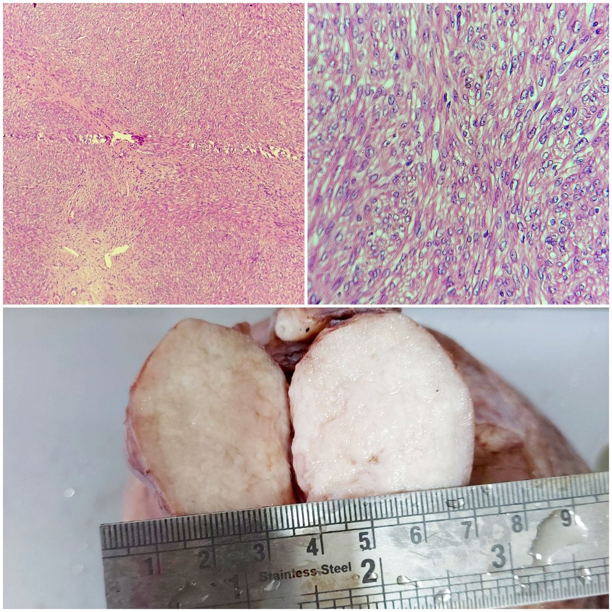 padmapathology1's tweet photo. #MacroMicroCorrelation
Case of cornual cellular leiomyoma
*Gross-nodular grey white cut surface
*🔬spindle cells with fusiform nuclei, presence of thick-walled vessels and reticulin pattern parallel to fascicles hello to differentiate from stromal tumors
#gynpath #PathTwitter https://t.co/fwOGntXMOB