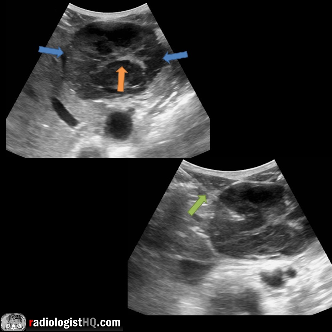 Radquarters's tweet image. Liver mass mimicking FNH. Female patient w/ large, exophytic mass (blue). Echogenic, stellate central scar (orange). Biopsy (green) = Melanoma. Beware: Central scars are nonspecific. Can be seen w/ FNH, large hemangiomas, HCC &amp;amp; metastases.
#FOAMrad #radiology #radres#medstudent