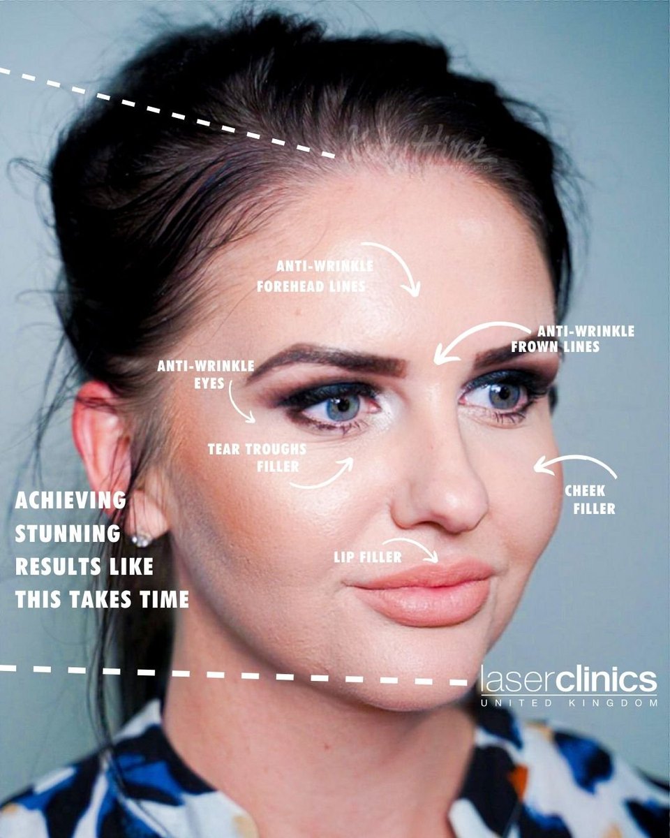 bewildered_by's tweet photo. Achieving stunning results like this doesn't happen overnight and it definitely doesn't happen with 1ML.

Meet our stunning client Meghan 💋

This face map shows you the areas that have been worked on and the amount of work that does go into giving you a ...
@laserclinicsuk_liver https://t.co/9VZpK8ZQGA