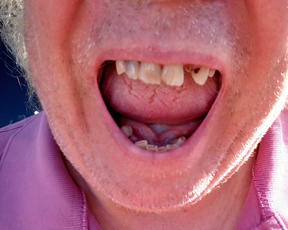 HOMELESS DENTAL HELP PLEASE
#NFT #NFTS #CharityNFT 

opensea.io/assets/matic/0…

This #NFT shows the poor dental health of a once popular artist who is now disabled and homeless.

Kicked out numerous hospitals run by <a href="/GovRonDeSantis/">Ron DeSantis</a> in Florida trying to get dental care
PLEASE HELP